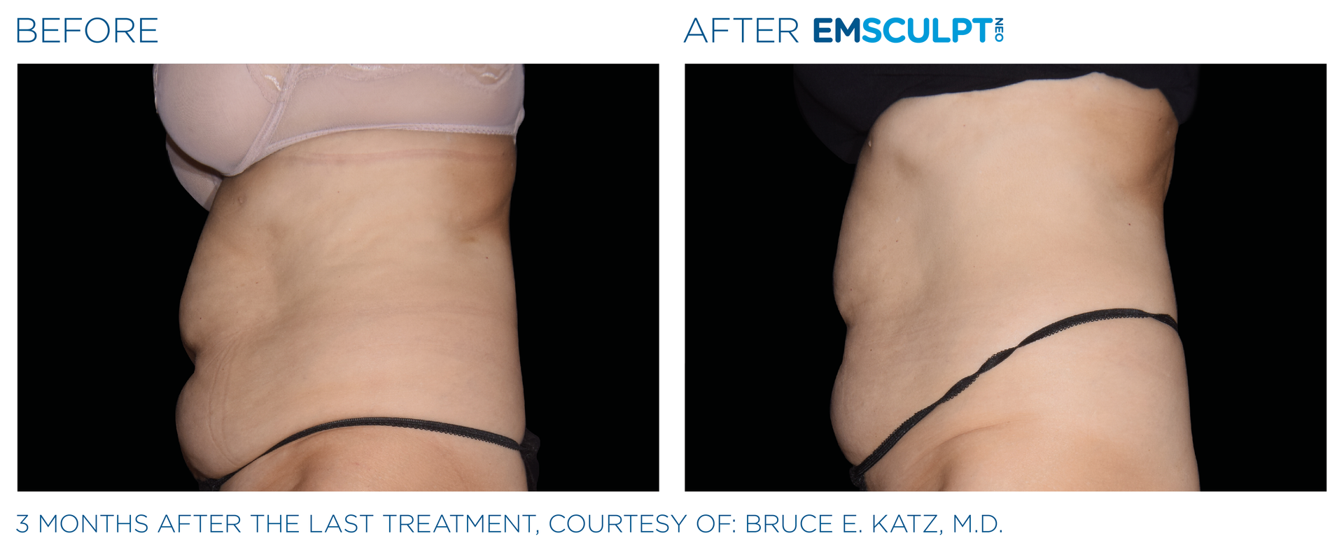 3 months after last treatment of woman's abdomen