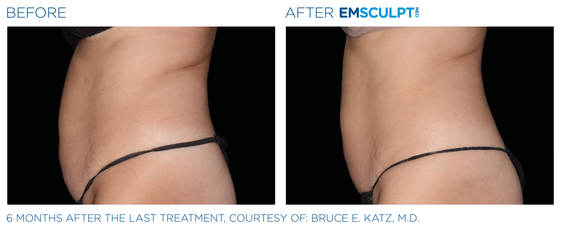 6 months after last treatment of woman's stomach