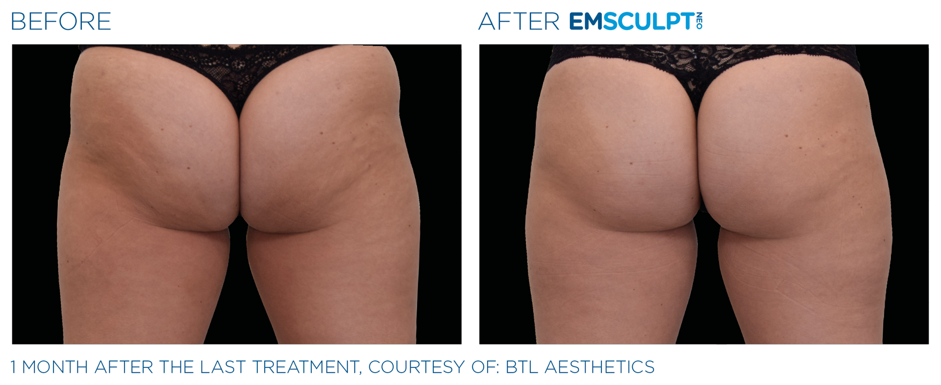 1 month after last treatment of woman's buttocks