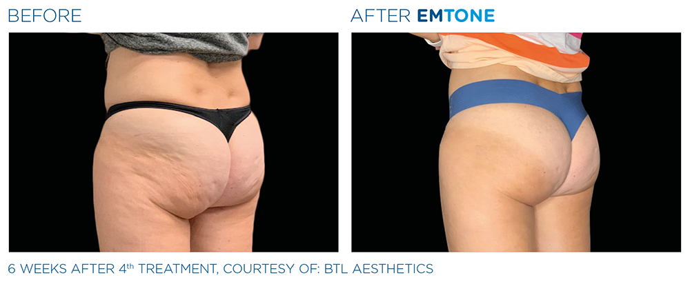 6 weeks after 4th treatment of buttocks