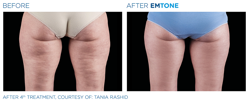 After 4th treatment of woman's buttocks