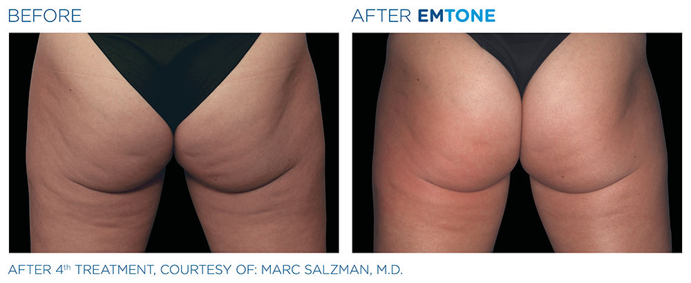 After 4th treatment of buttocks
