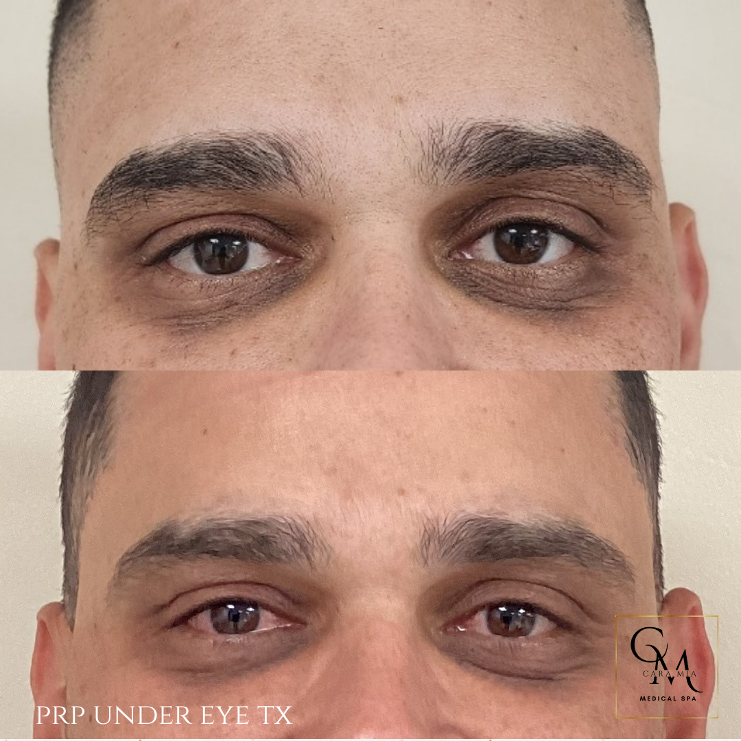 Before and after comparison of a person's under-eye area following a PRP treatment, showing a reduction in dark circles.