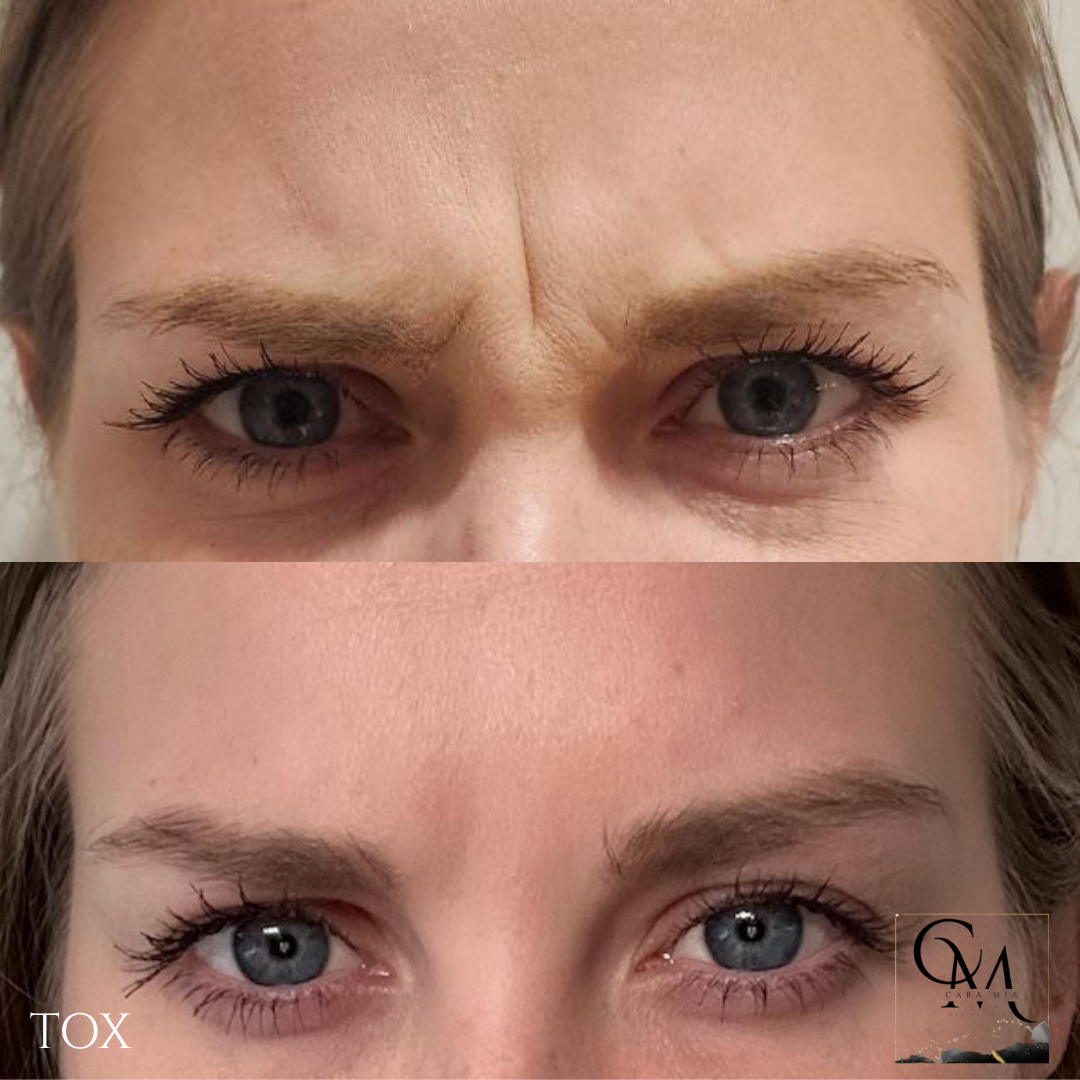Before and after comparison of forehead wrinkles treated with botulinum toxin.