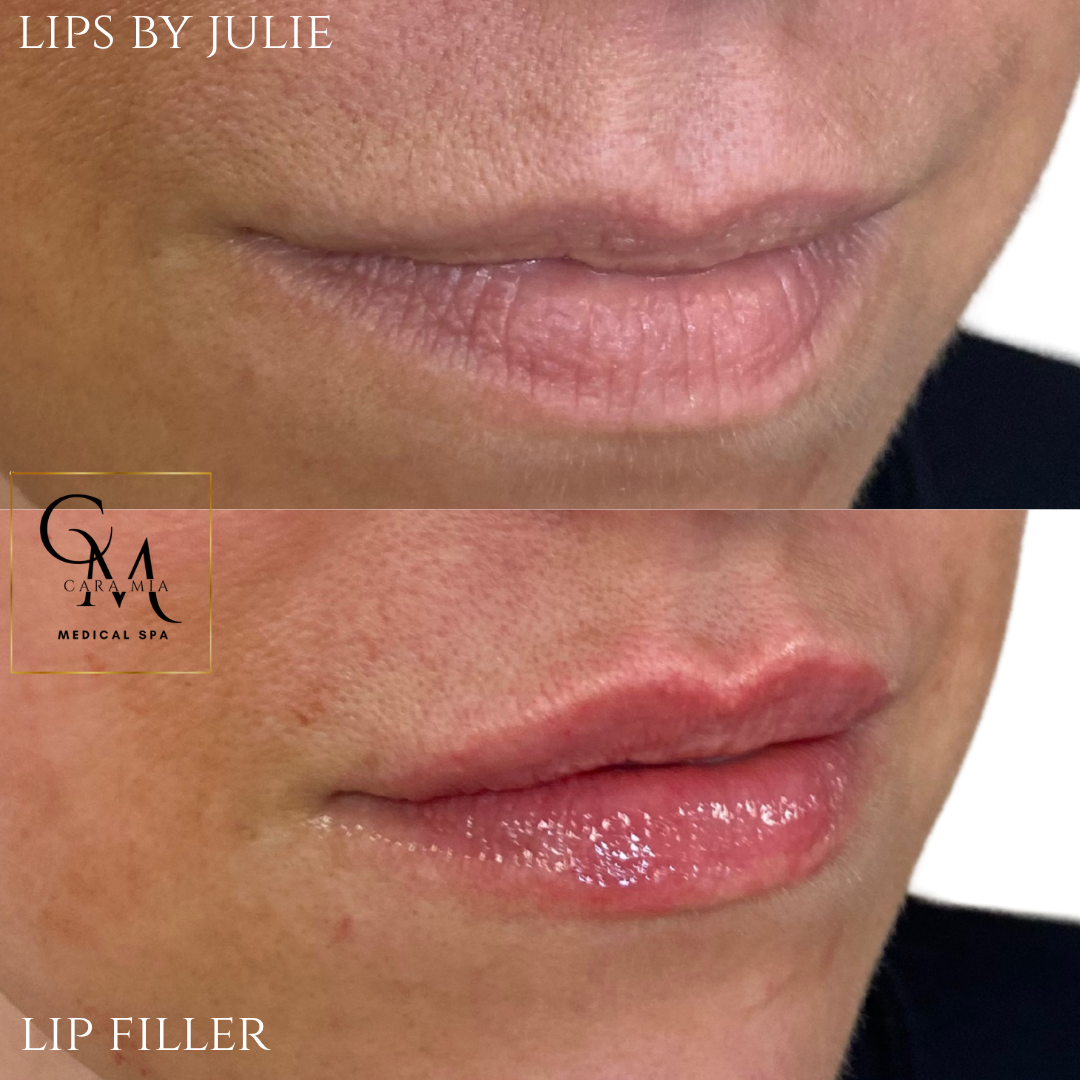 Comparison of lips before and after lip filler treatment. Bottom lips are fuller, glossier.