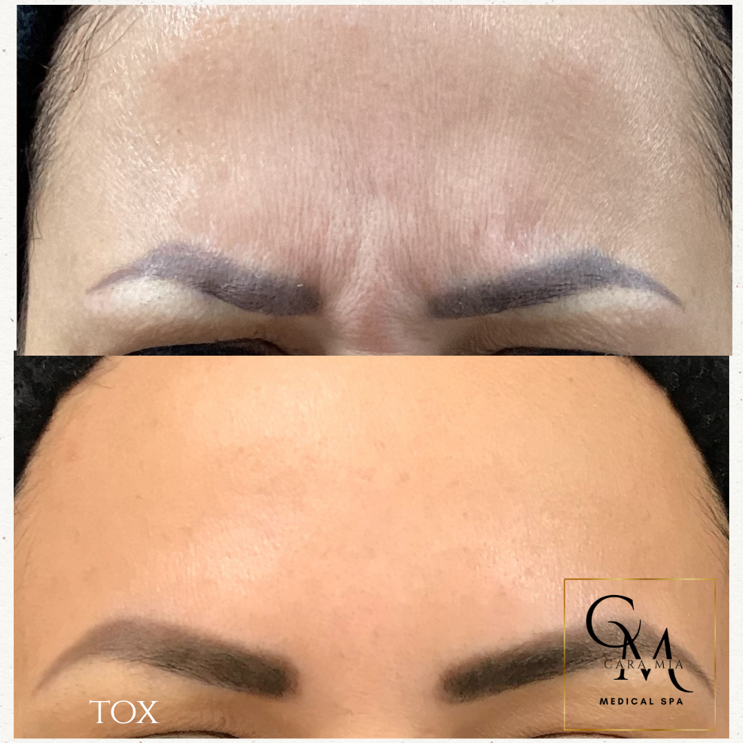 Forehead wrinkles before and after treatment, reducing lines.