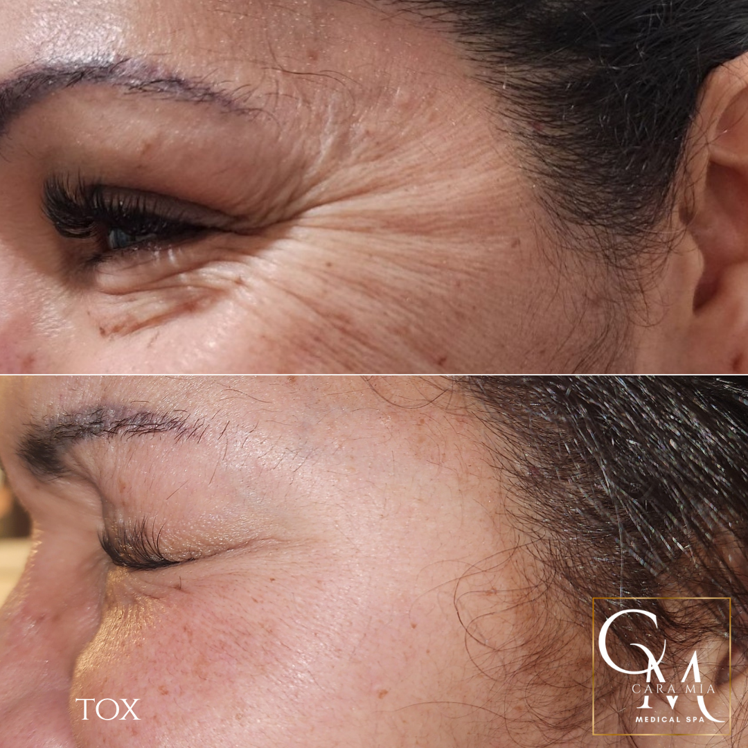 Before and after comparison of a person's crow's feet wrinkles, showing reduction after cosmetic treatment.