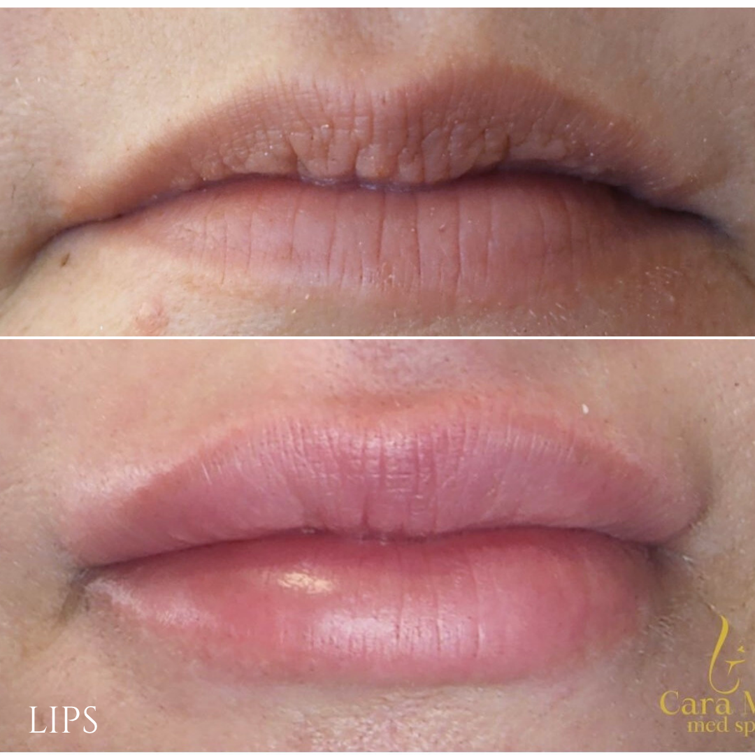 Lip augmentation comparison: Top, thin lips; bottom, fuller, pinker lips.
