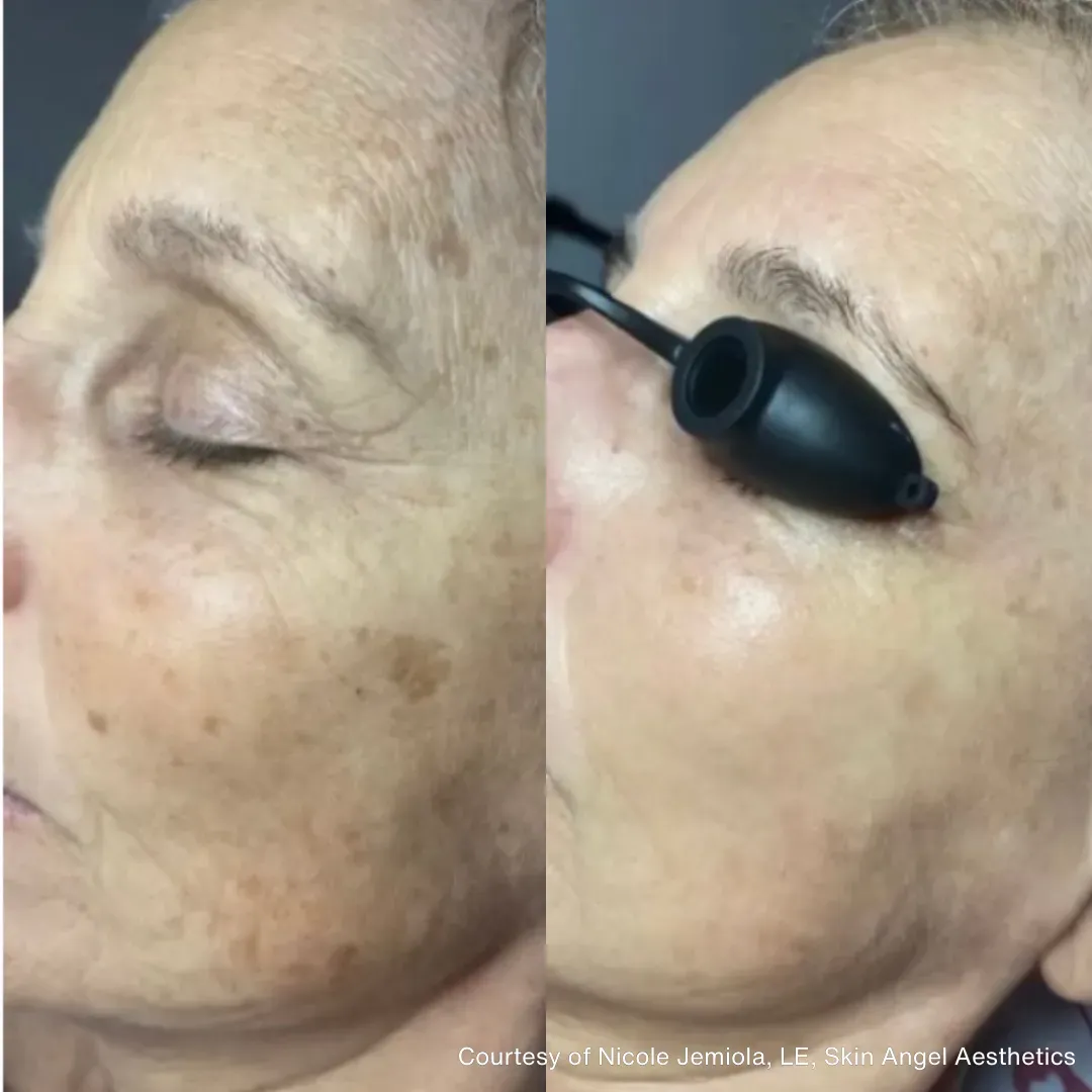 Side-by-side comparison: face with sunspots before laser treatment (left) and during treatment (right).
