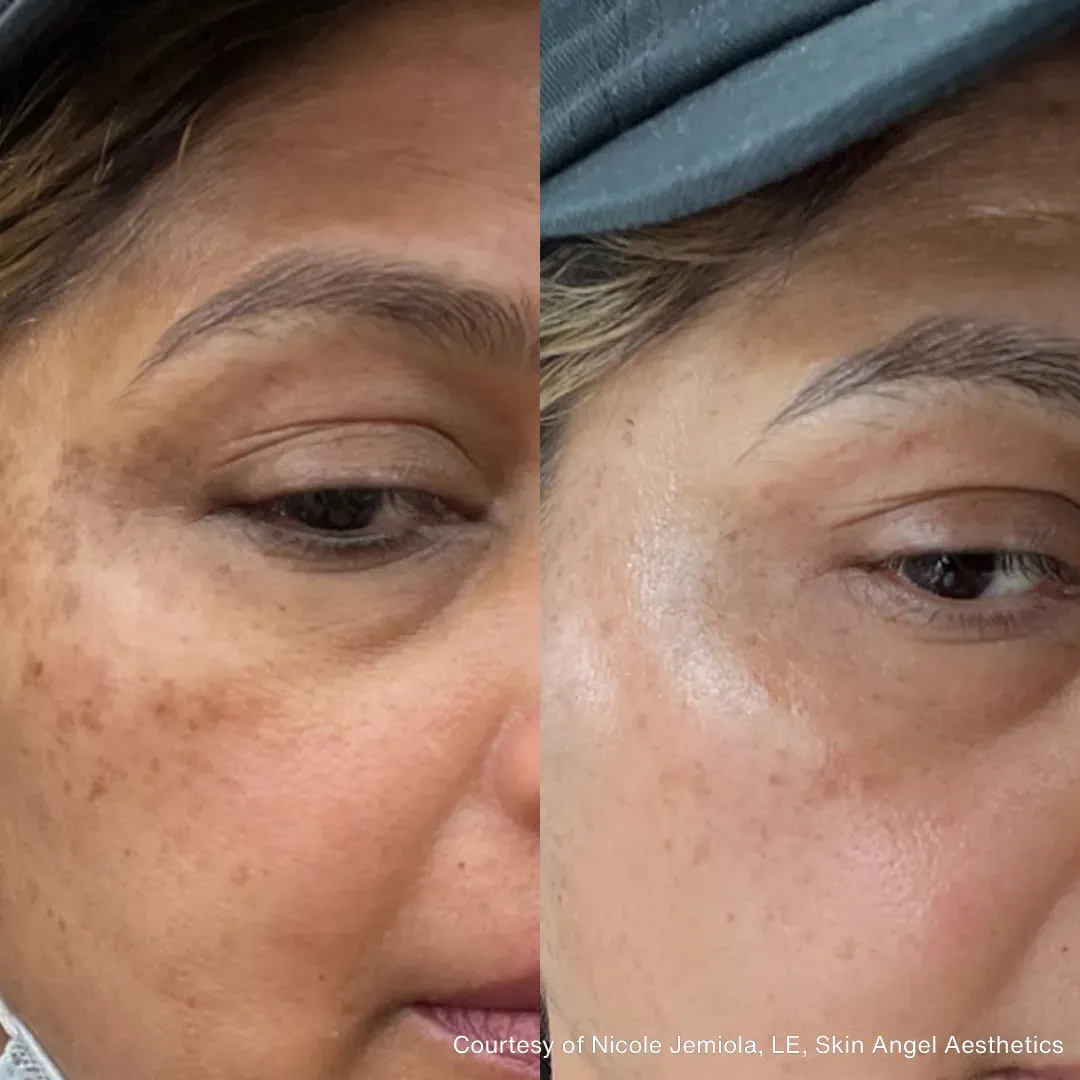 Comparison of skin before and after treatment, showing reduction in dark spots and improved skin tone.