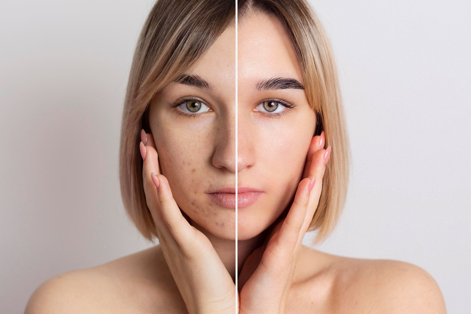 A split-screen comparison of a face showing skin texture differences, with one side having acne and the other being clear.