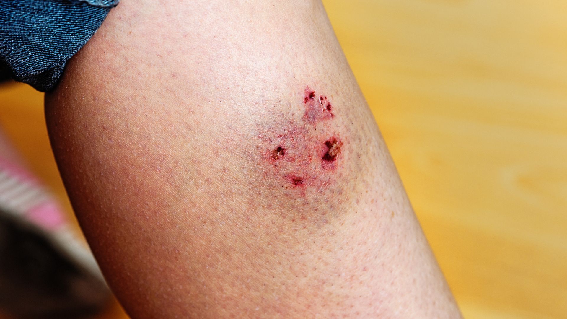 Close-up of a forearm with a small red scrape and bruising on skin