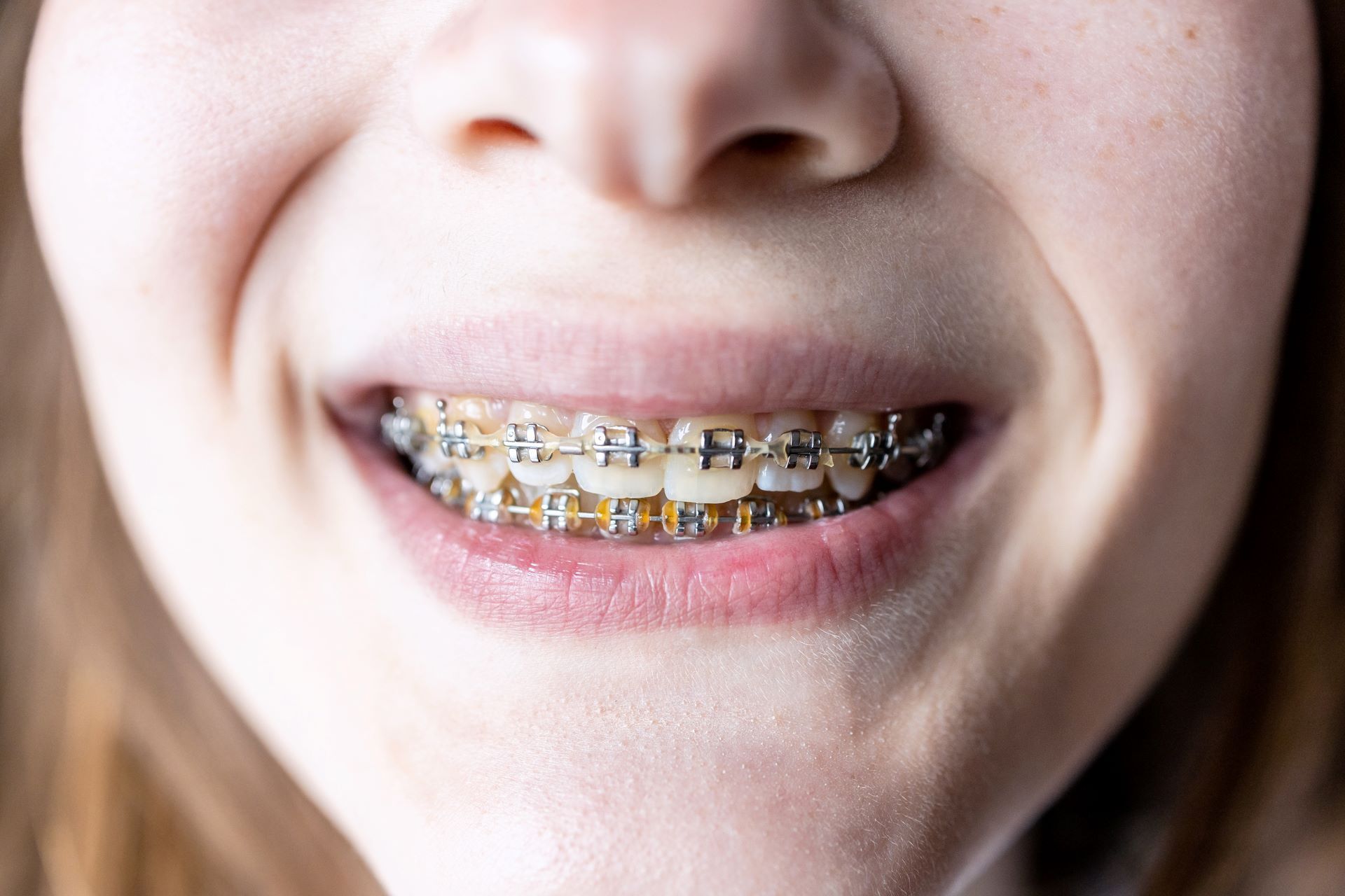 Close-up of a person smiling, showing their teeth with silver metal dental braces on both the upper and lower arches.