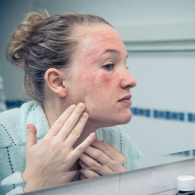 dermatitis atópica