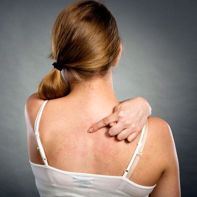 urticaria crónica