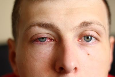conjuntivitis, alergólogo