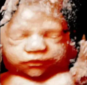 Close-up of a baby’s face with eyes closed and a reddish tint, against a dark background