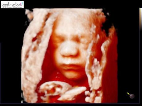 3D ultrasound showing a fetus in the womb, with a visible face and hands near the chin