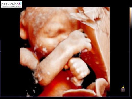 Ultrasound-style image of a curled baby in the womb, with arms and legs visible