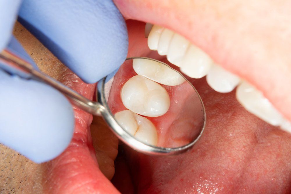 Fissure Sealants — Belconnen, ACT — Belconnen Dental Centre Fissure Sealants — Belconnen, ACT — Belconnen Dental Centre