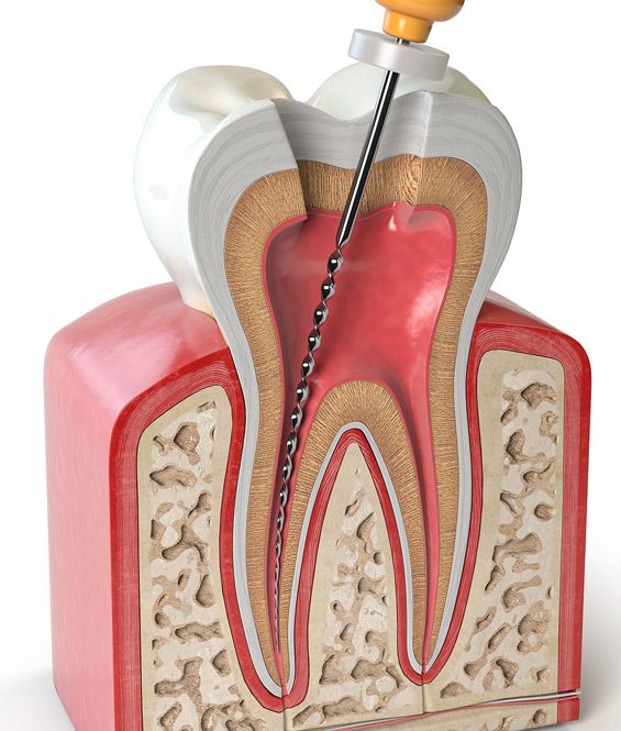 Cross-section of a tooth undergoing root canal procedure, showing the internal structure and instruments.