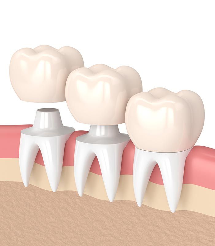 Dental crowns placed on teeth; cross-section of gums and teeth showing restoration process.