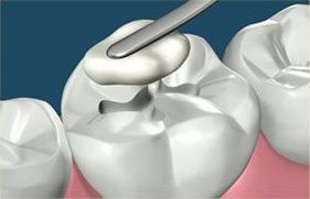 Dental filling being applied to a molar with a silver instrument.