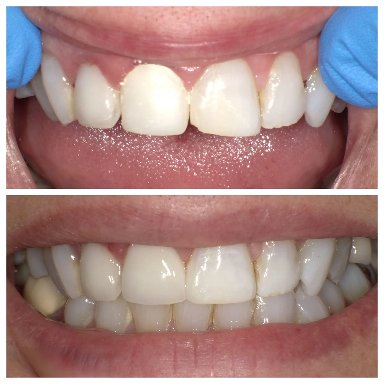 Before-and-after close-up of teeth, showing white upper front teeth with improved alignment.