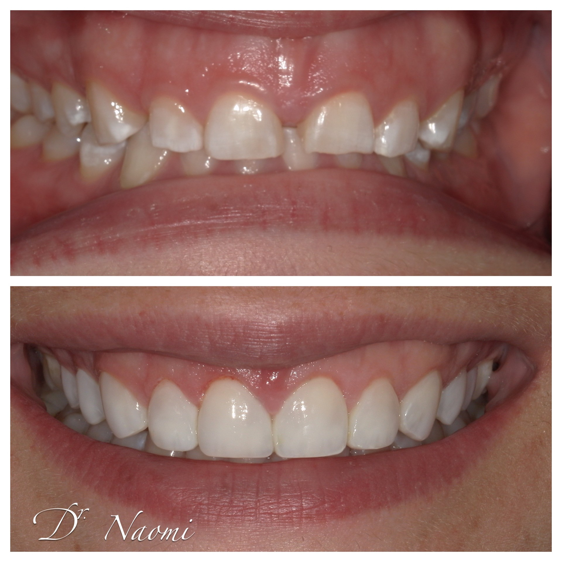 Before-and-after close-up of teeth, showing a straighter, more even smile in the lower image.
