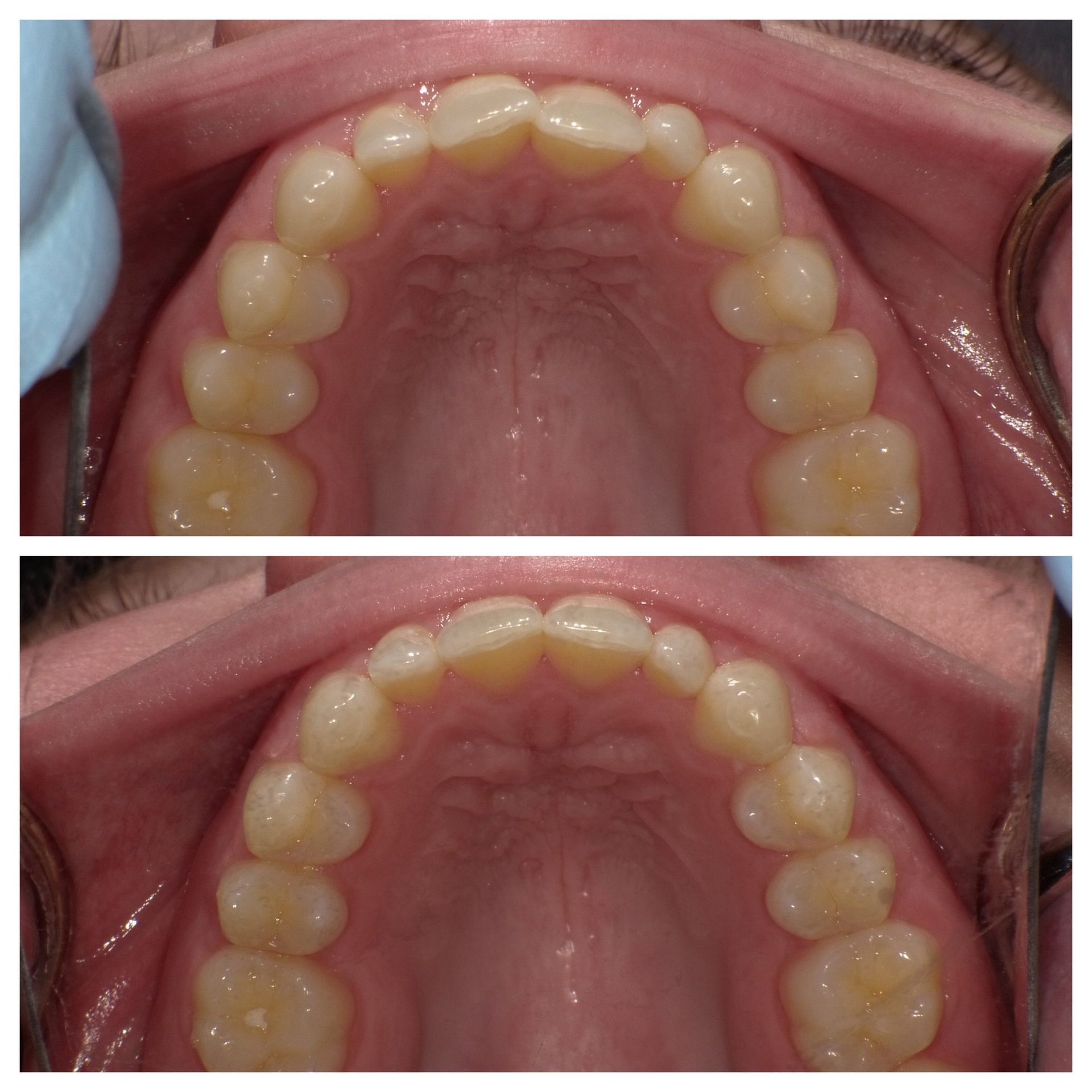 Upper dental arches in two close-up photos, showing the roof of the mouth and teeth from above.