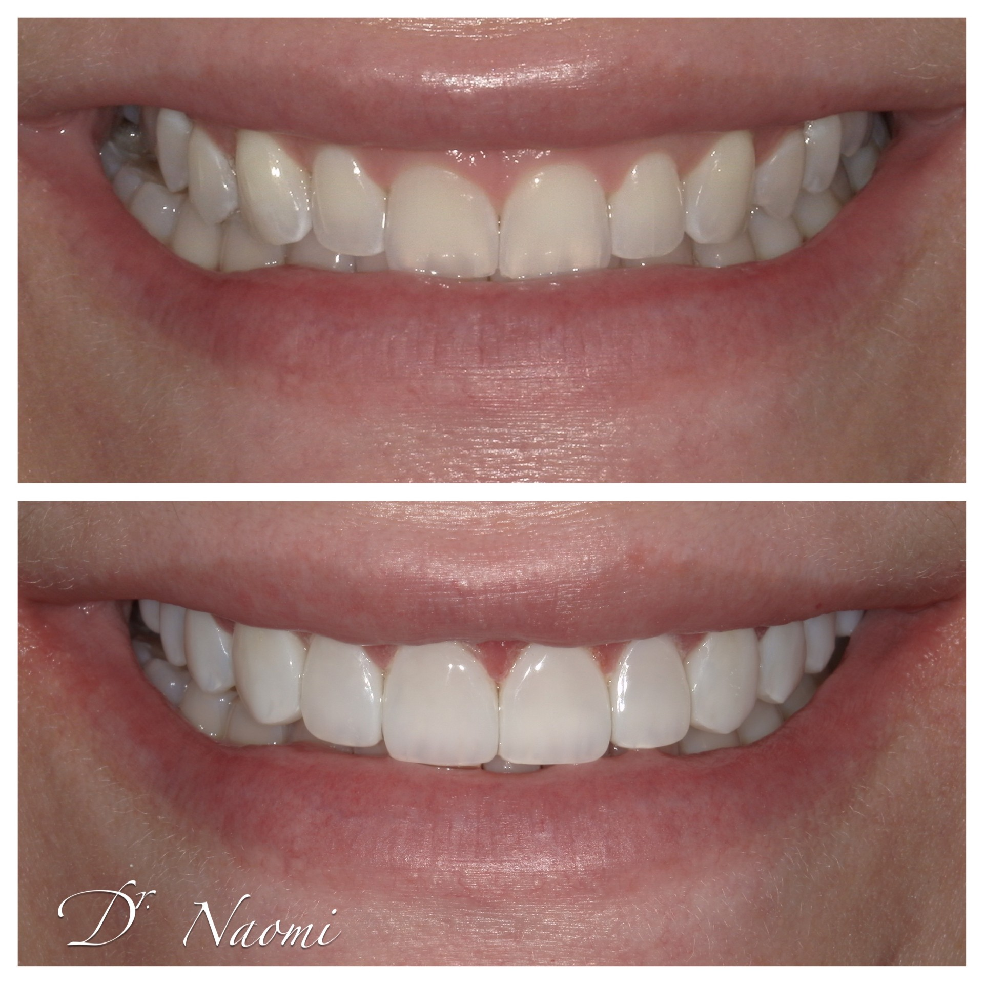 Before-and-after close-up of a smile with whiter teeth, split into two horizontal panels.