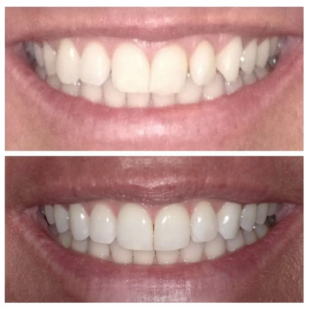Two close-up photos of a smiling mouth, showing teeth before and after whitening.