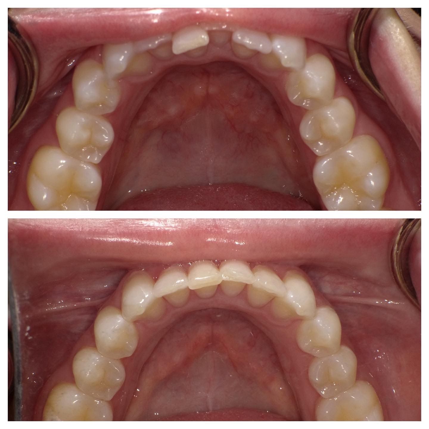 Close-up of upper teeth and palate, shown in two dental photos from the top view.