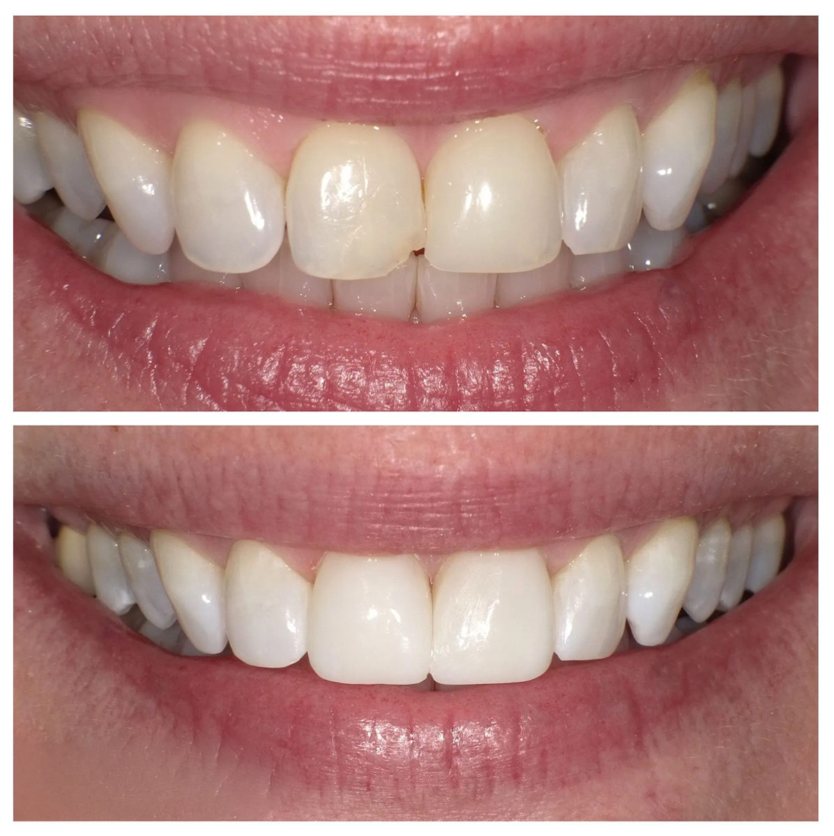 Close-up of a smiling mouth showing two side-by-side views of white teeth, before and after whitening