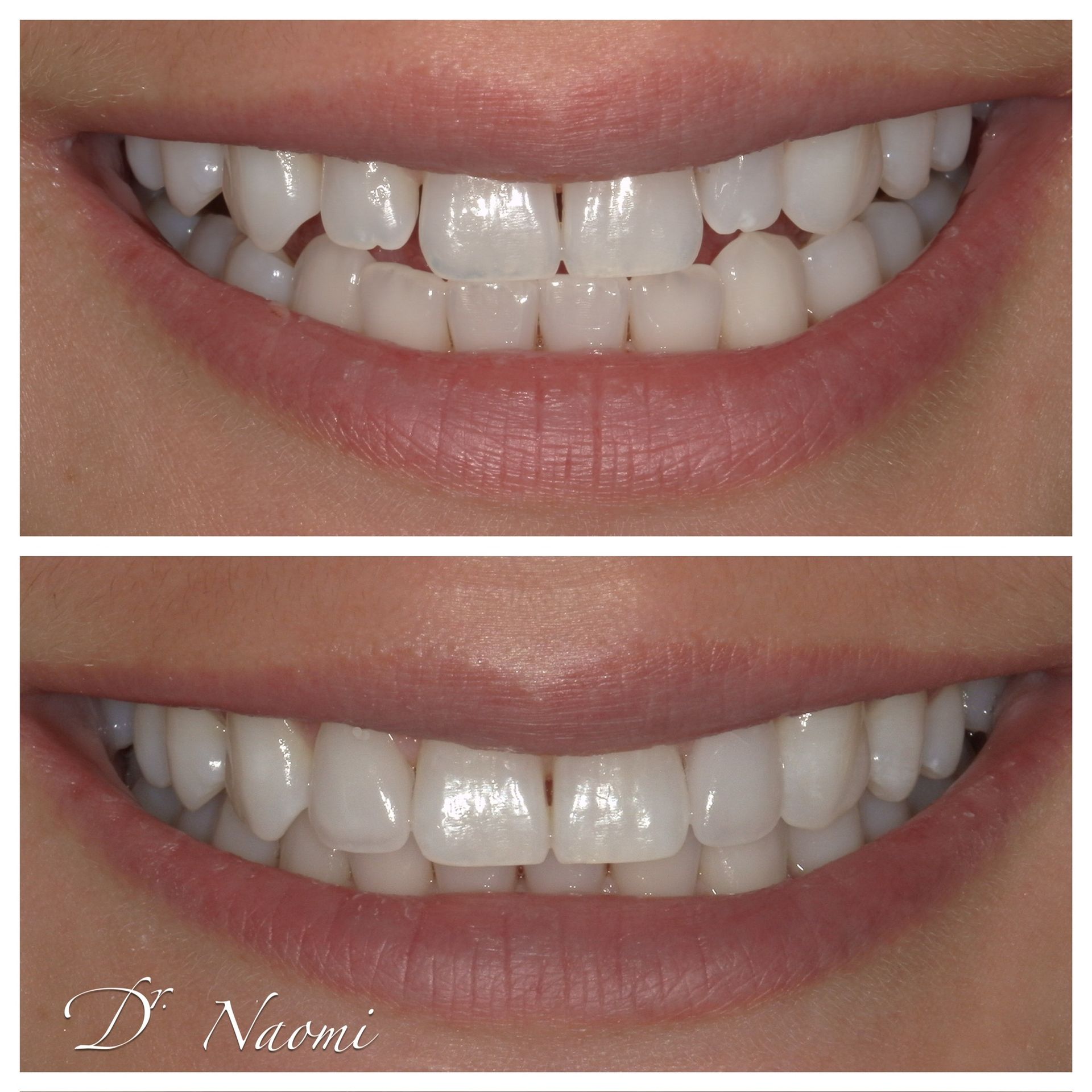 Close-up of a smiling mouth showing teeth before and after whitening treatment
