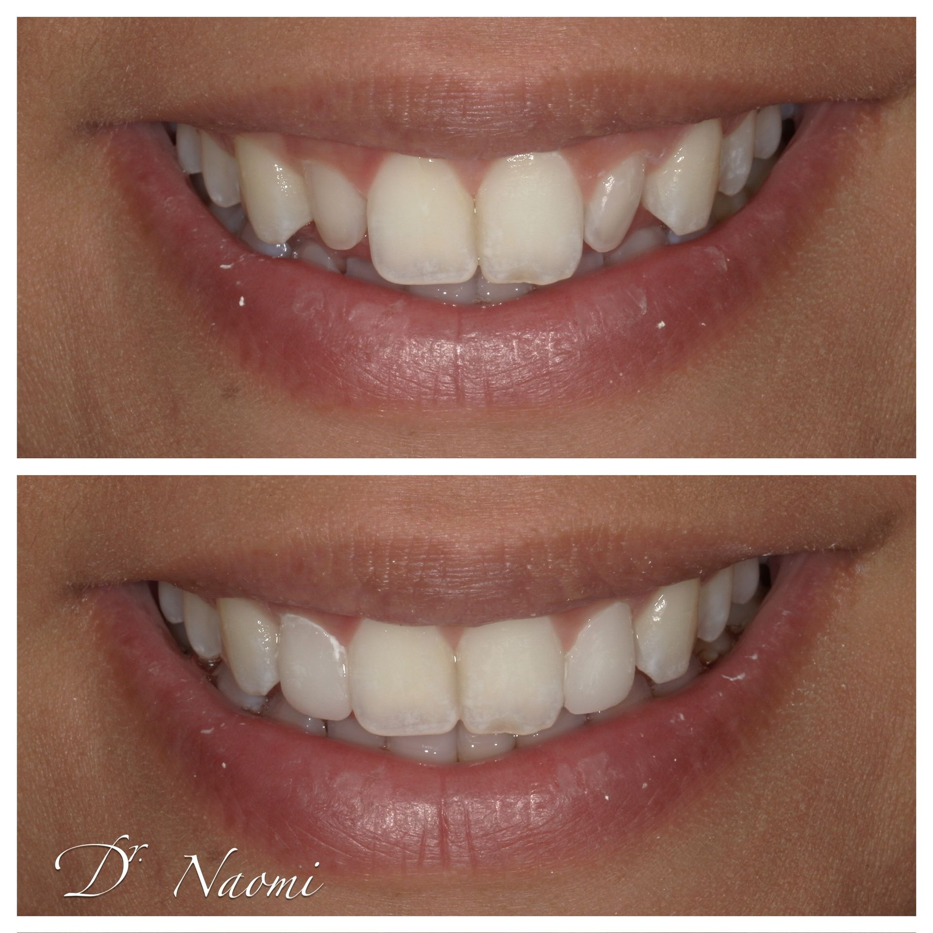 Close-up of a smiling mouth, showing teeth before and after whitening treatment.