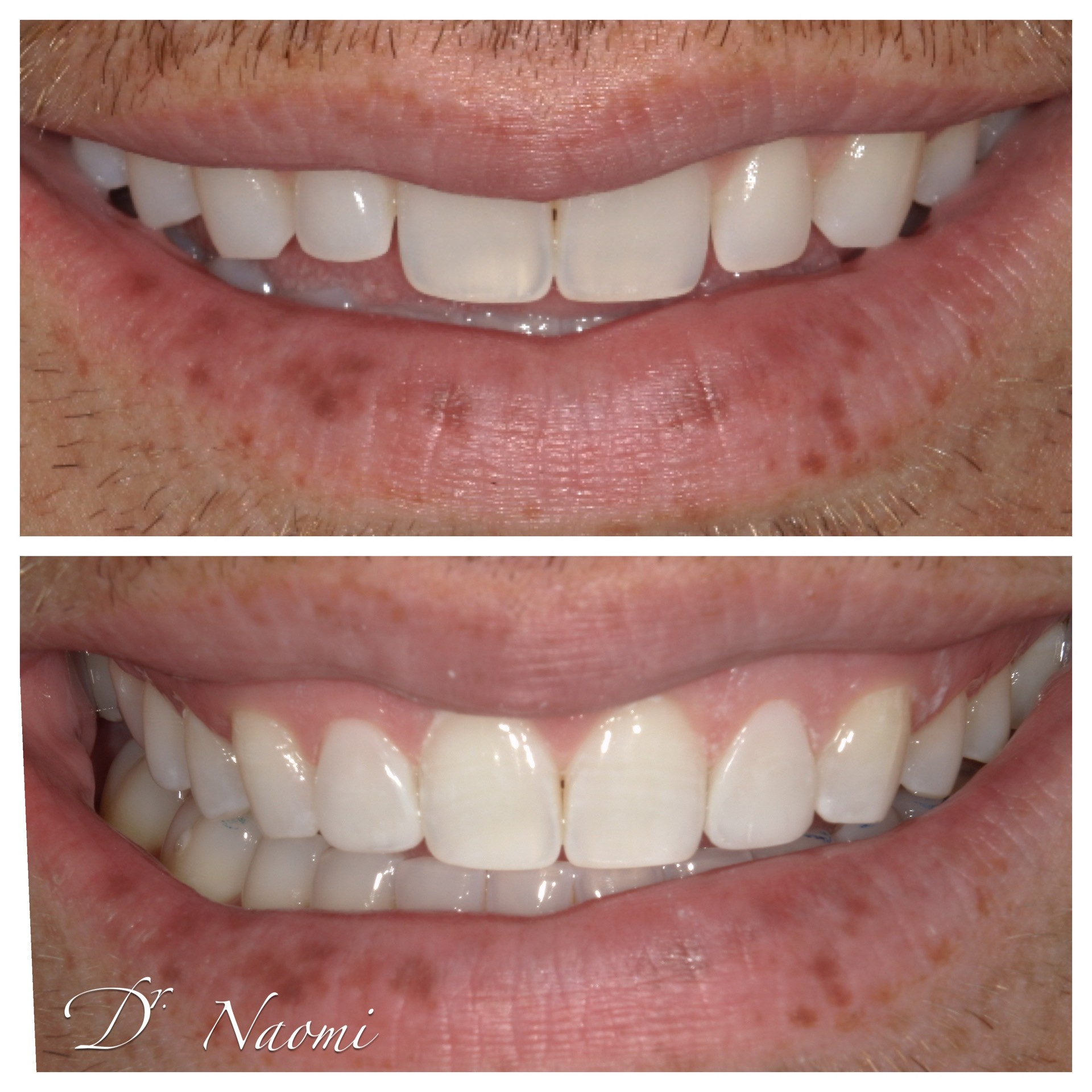 Before-and-after close-up of a smile, with teeth appearing whiter in the lower image.