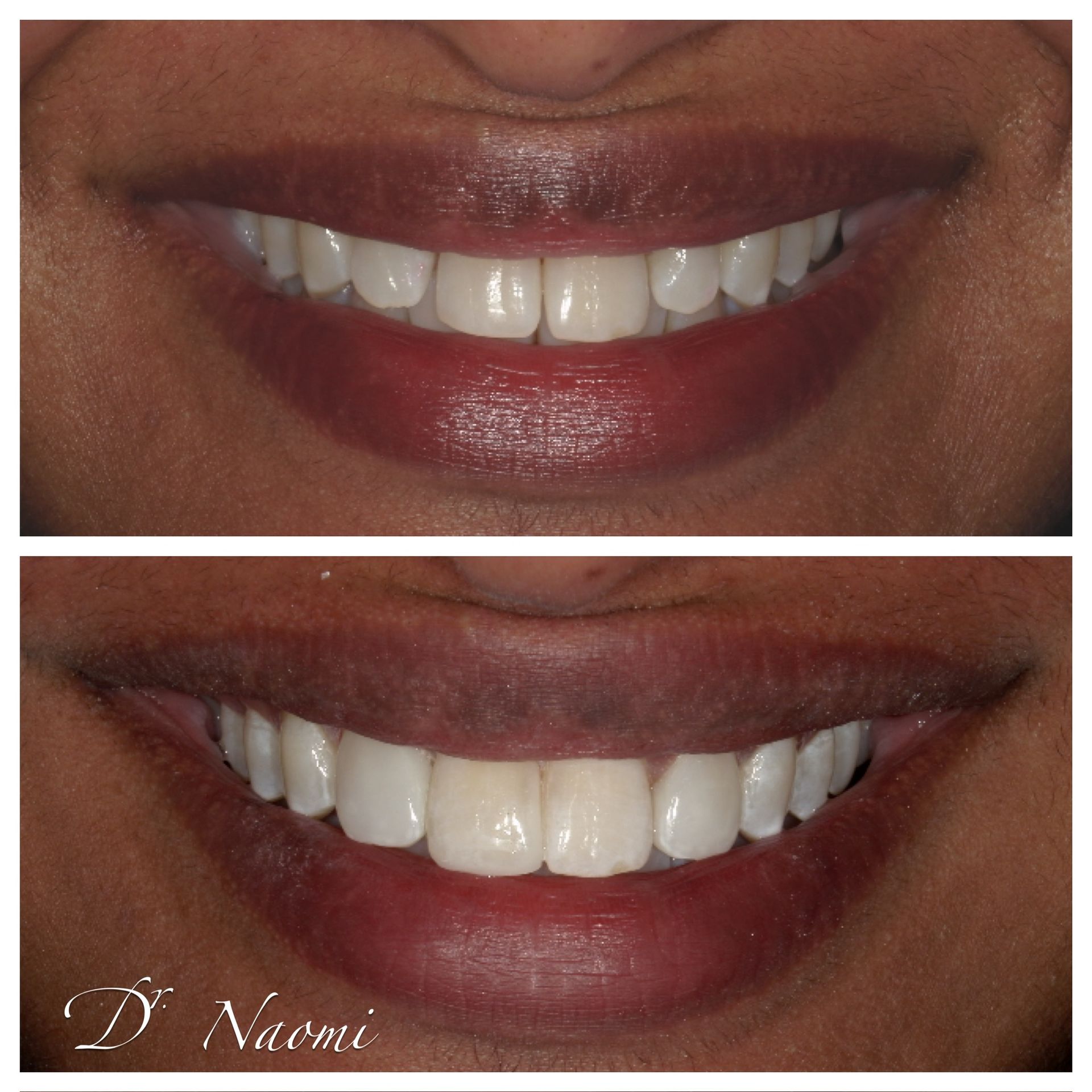 Close-up of smiling lips showing before-and-after teeth whitening results.