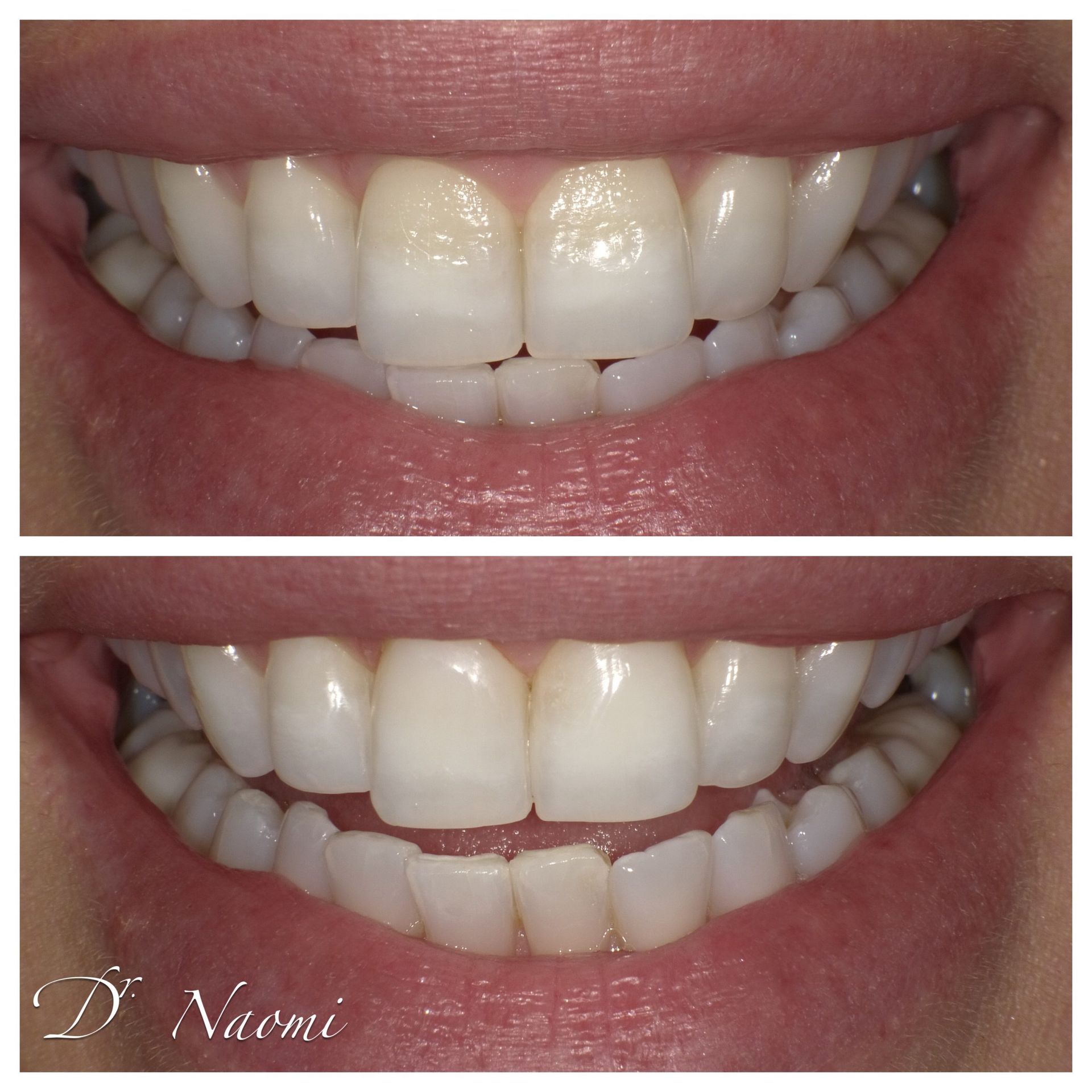 Before-and-after smile showing improved alignment and brighter teeth on a pink background