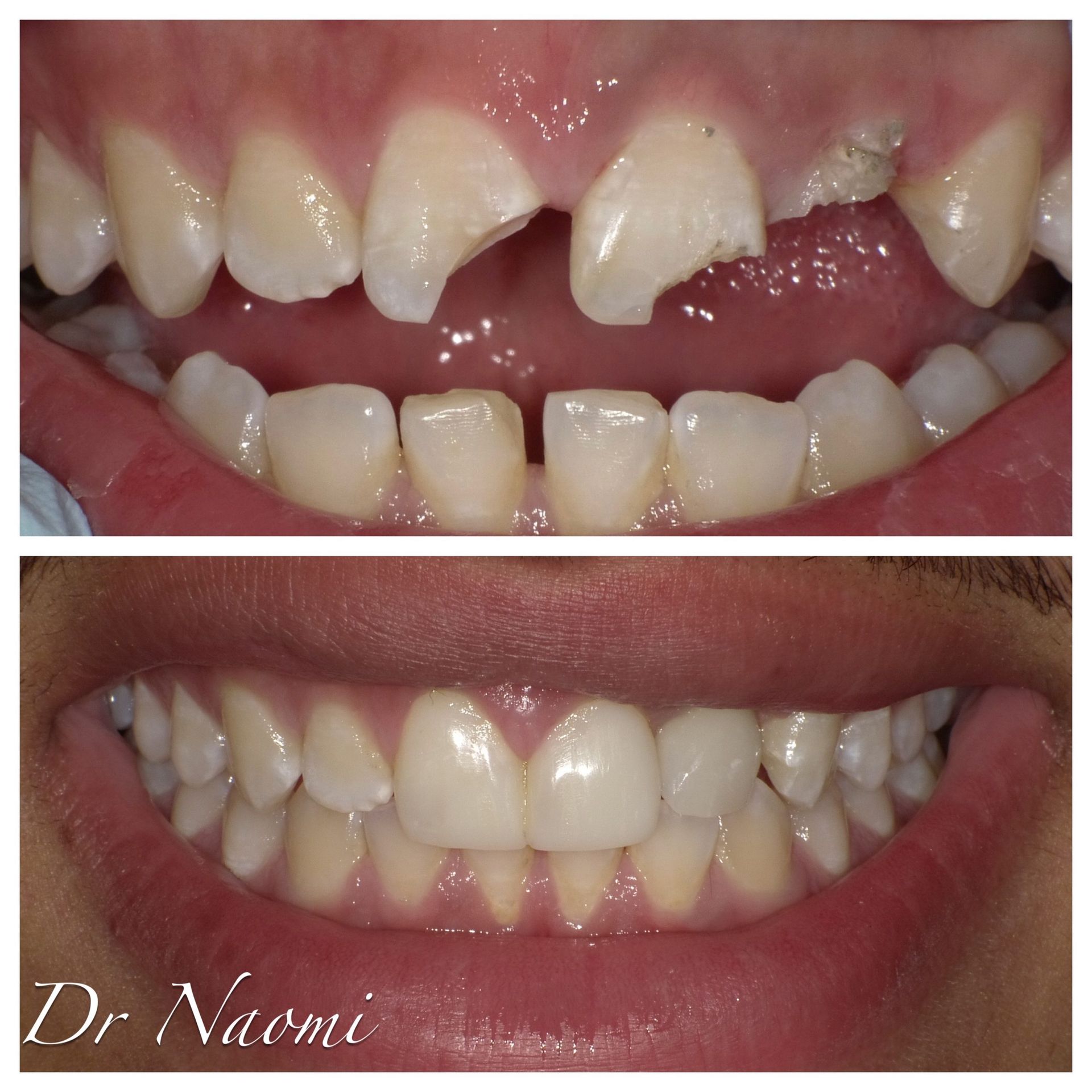 Before-and-after close-up of teeth: top shows broken, gapped front teeth; bottom shows a restored smile.