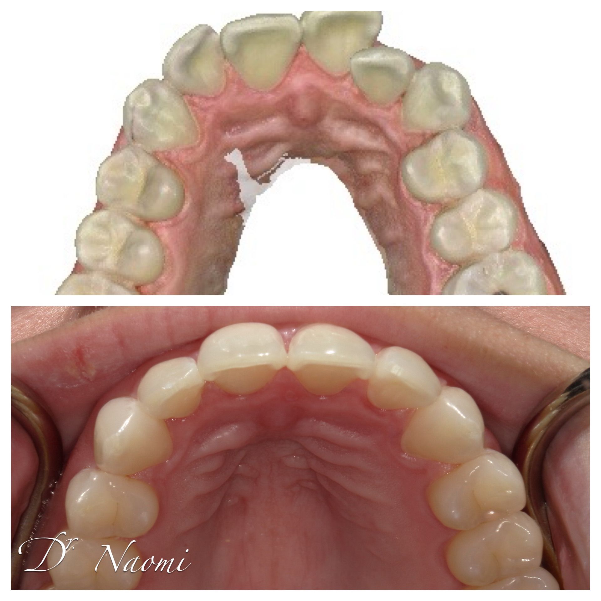 Upper and lower dental arch photos showing teeth and pink gums from inside the mouth