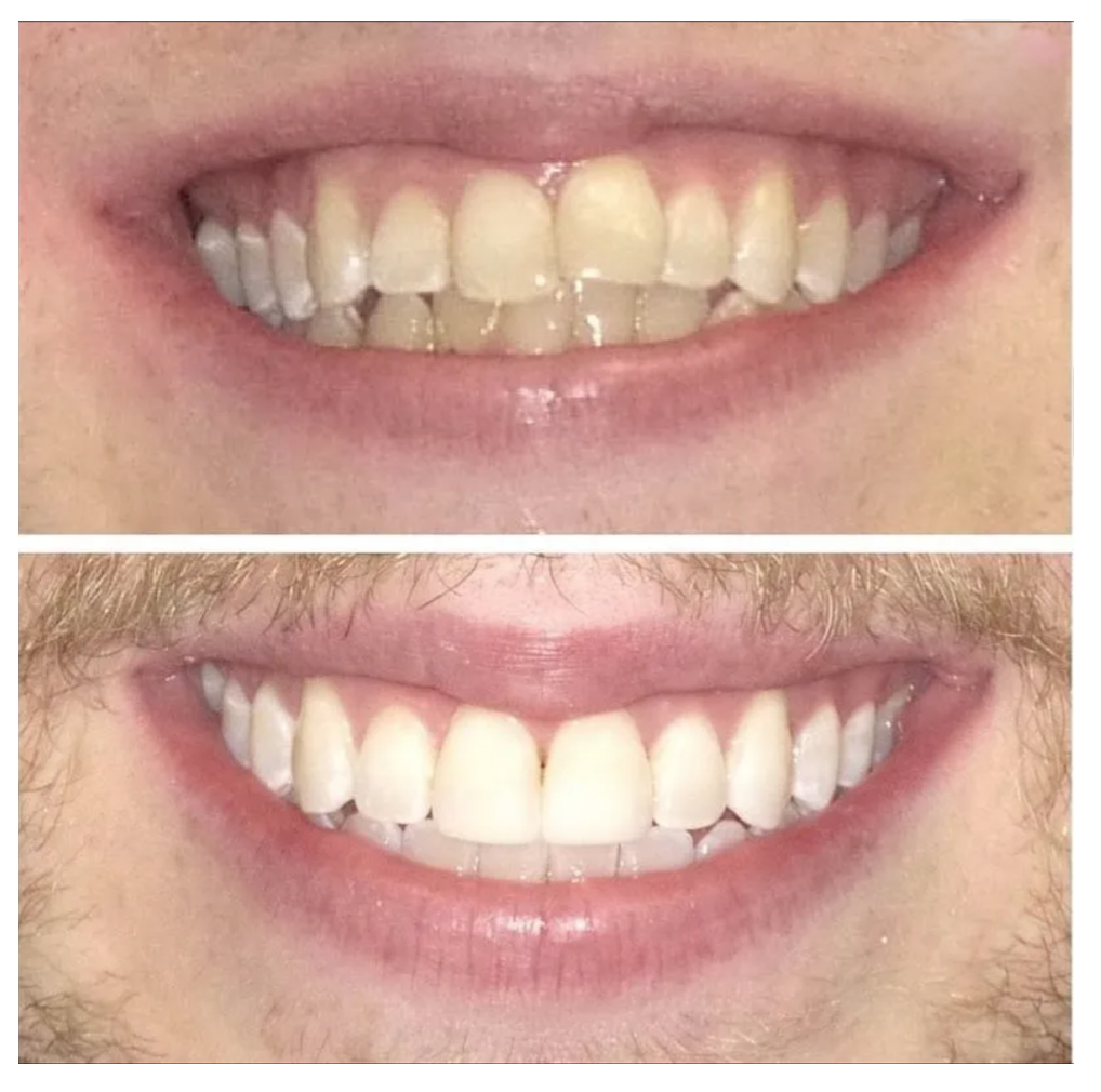 Before-and-after close-up of a smile, showing whiter teeth in the lower image.