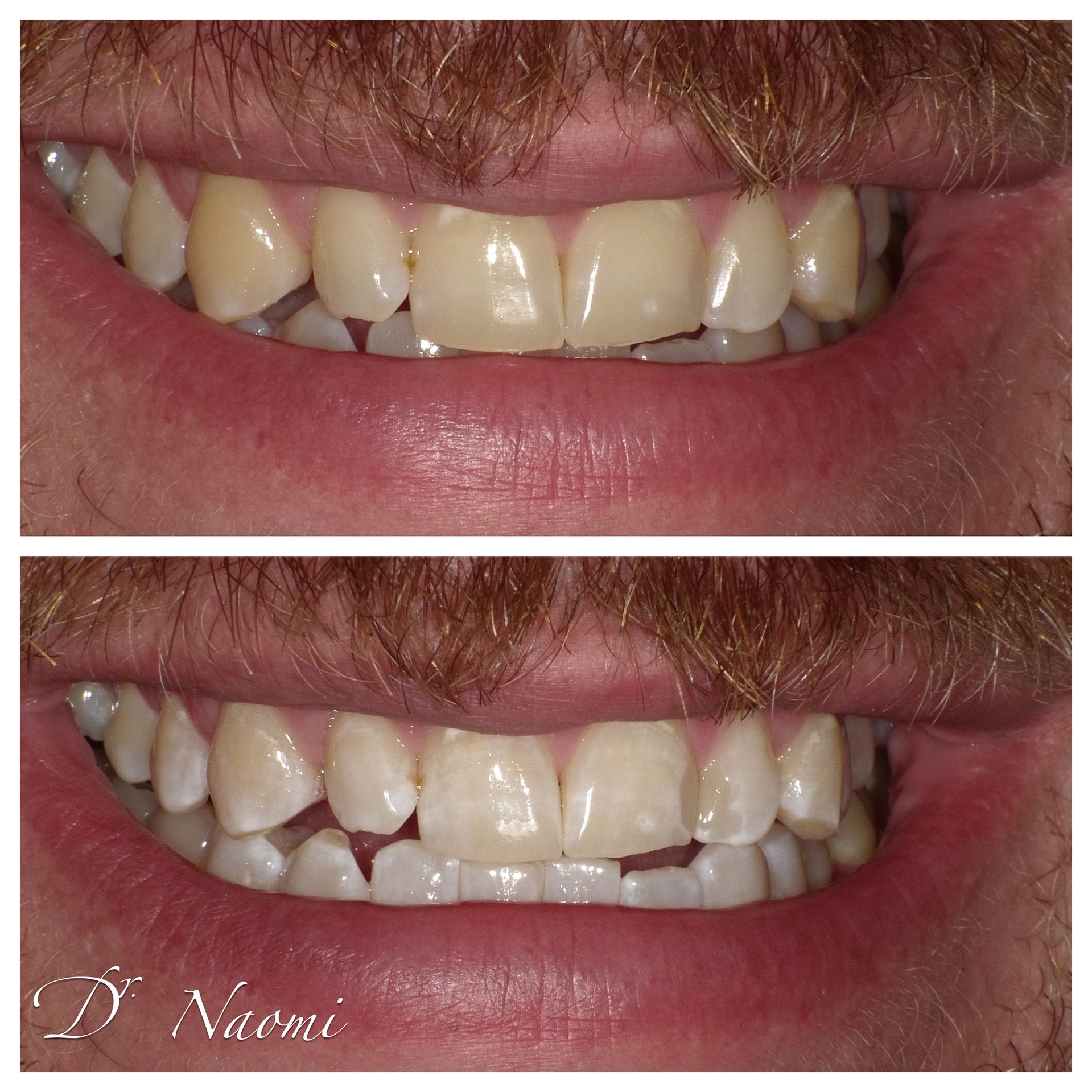 Side-by-side close-up of teeth before and after whitening, showing brighter white teeth in the lower image