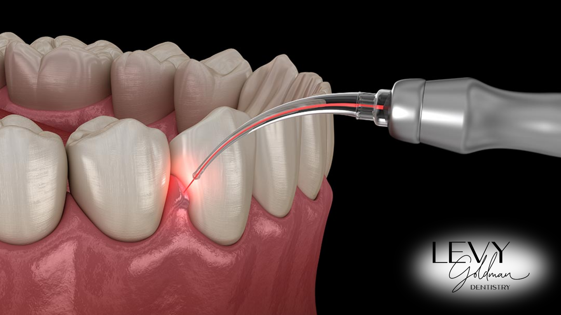 A close up of a person 's teeth being treated with a laser