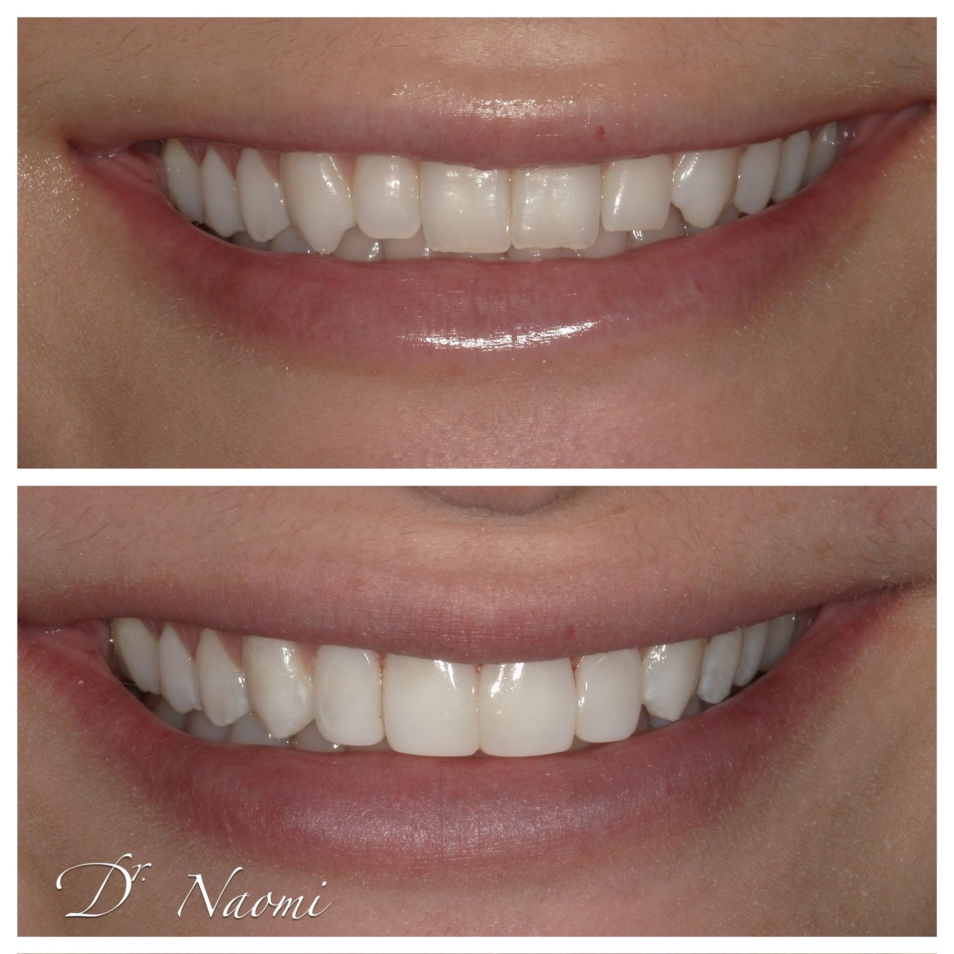 Side-by-side close-up of a smiling mouth showing teeth before and after whitening treatment