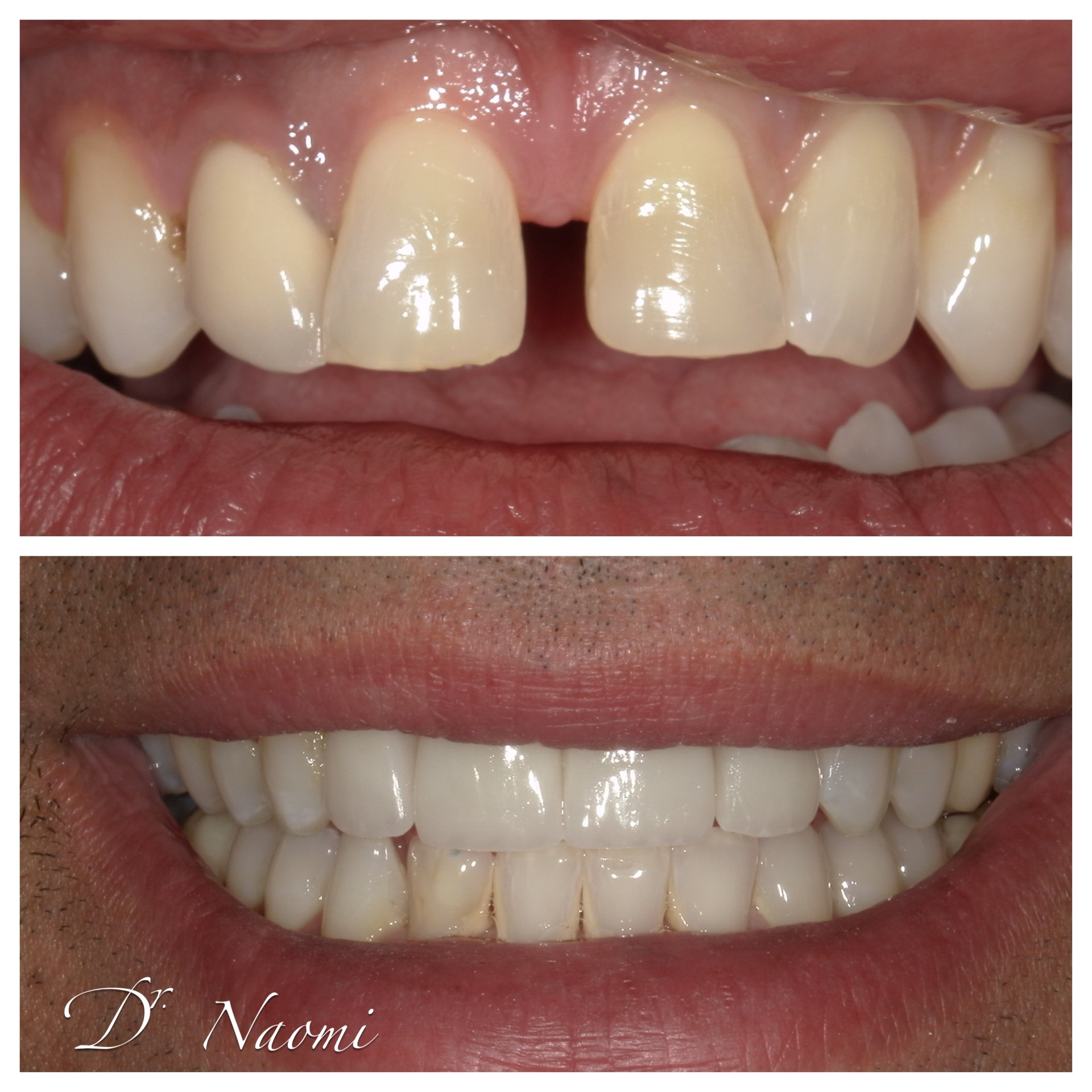 Close-up comparison of upper front teeth with a gap, and lower teeth with a whiter, straighter smile.