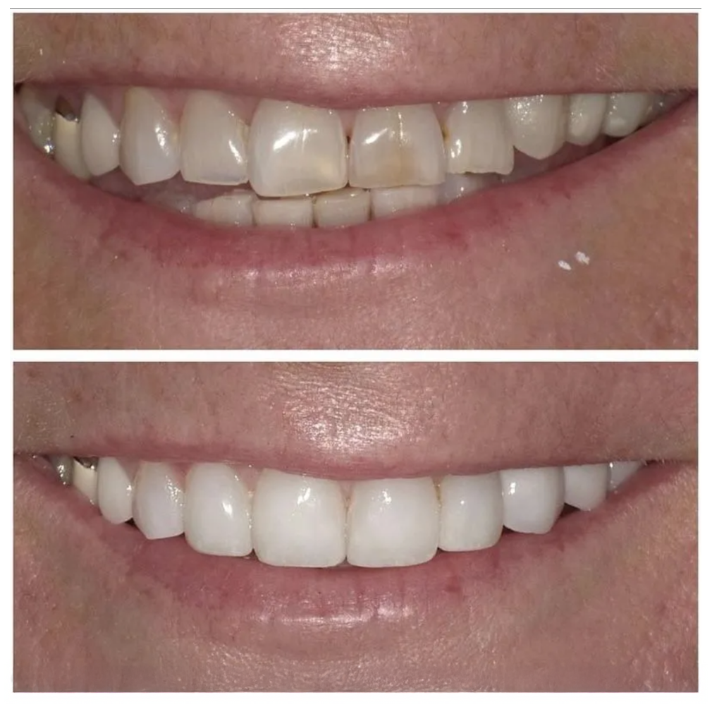 Before-and-after close-up of teeth whitening, with yellowed teeth above and brighter white teeth below.