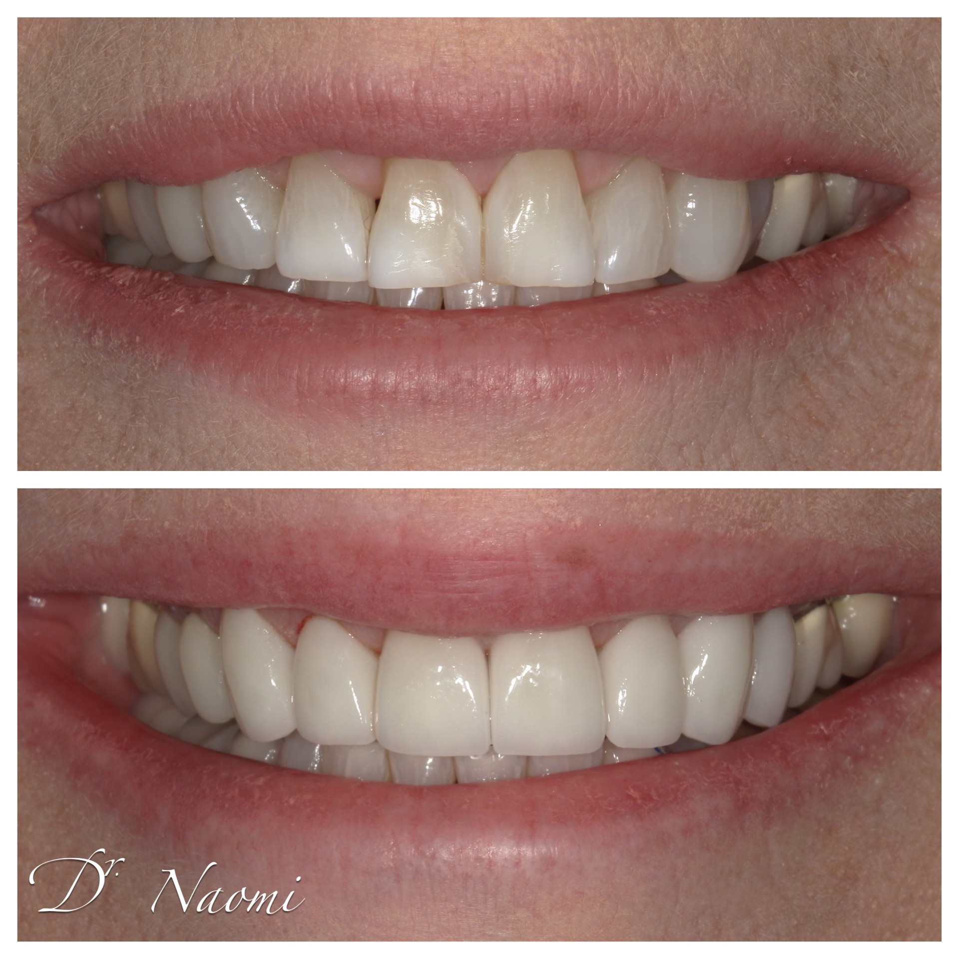 Before-and-after close-up of a smile, showing brighter, whiter teeth in the lower image.