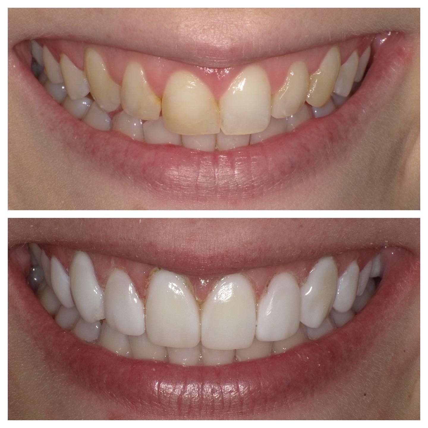 Side-by-side close-up of teeth before and after whitening treatment