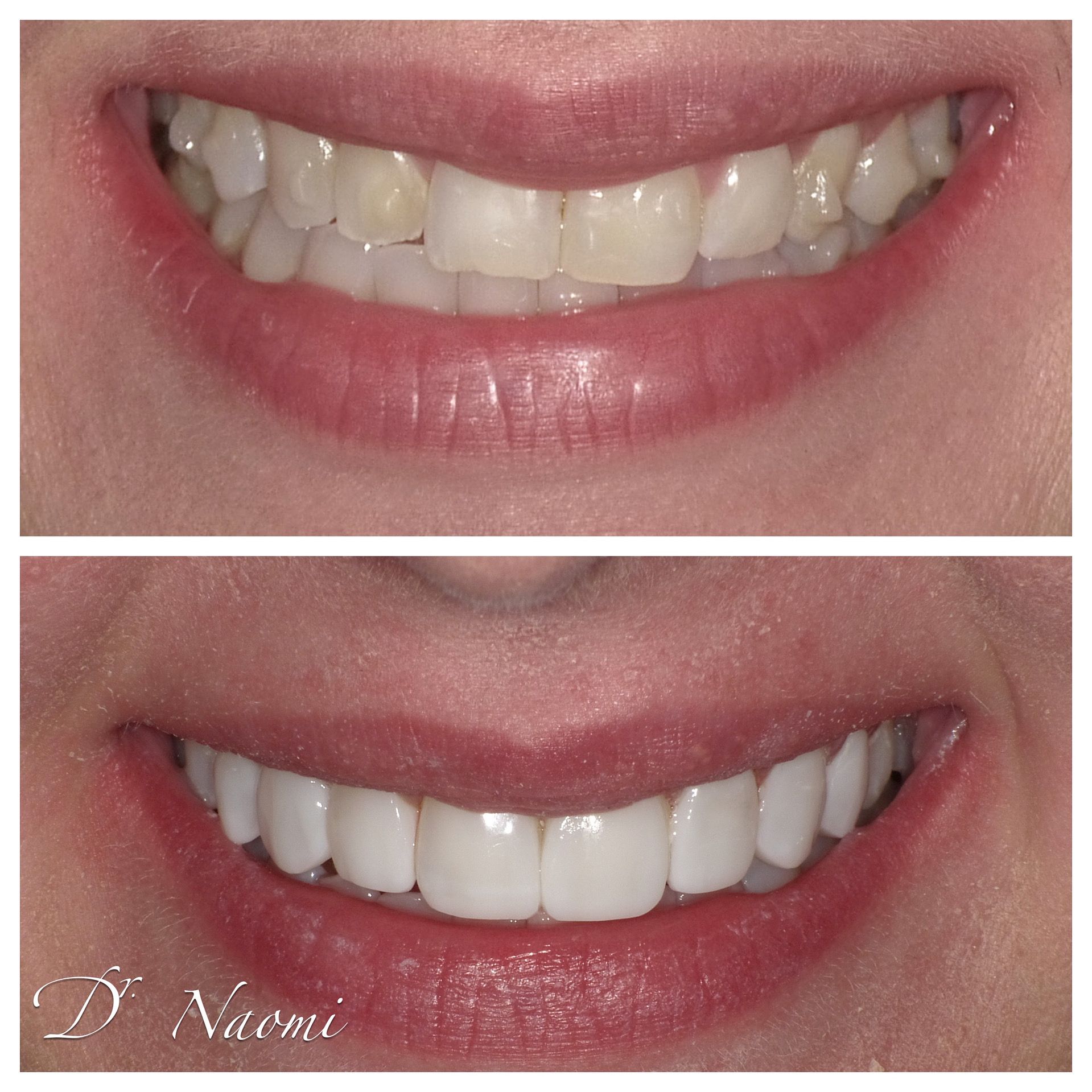 Before-and-after close-up of a smile, showing whiter teeth and fuller-looking lips.